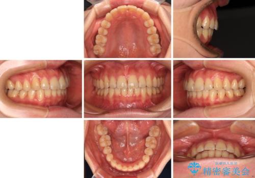 手間をかけずに治したい 短期間のワイヤー矯正の治療後