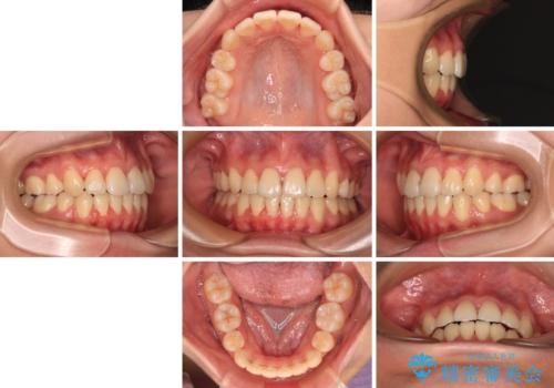 【モニター】舌のトレーニングを行いながら後戻りの再矯正の治療後