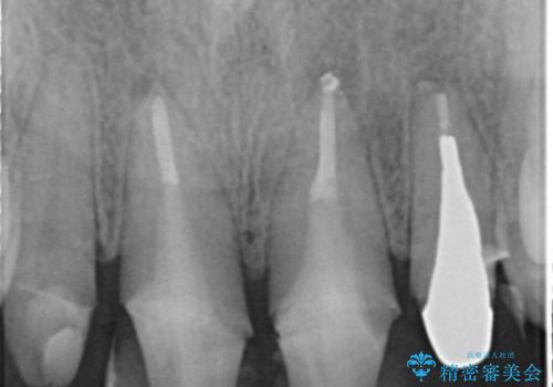 自然な前歯にしたい ジルコニアクラウンでの修復の治療前