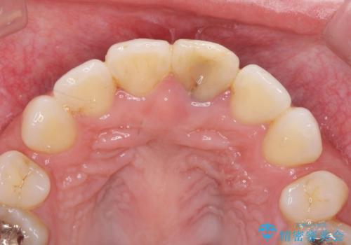 変色してきた前歯をセラミック治療の治療前