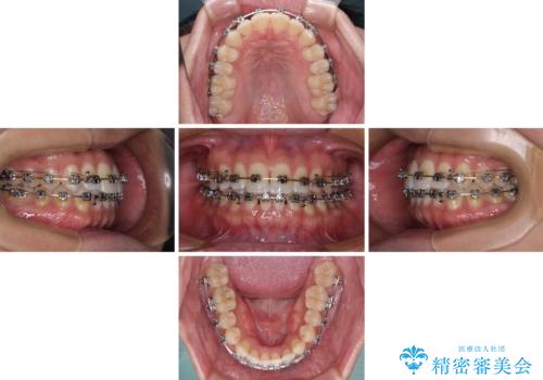 【モニター】楽して治したい メタルブラケットによる矯正治療の治療中