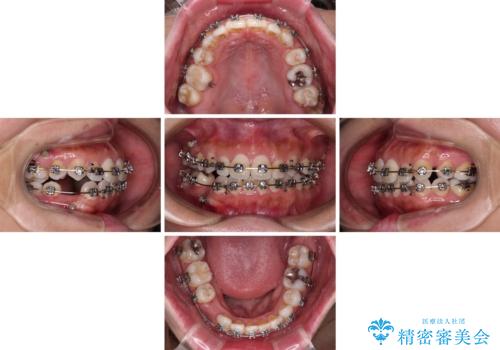 既に2本が抜歯されている歯列 咬み合わせのズレを改善する抜歯矯正の治療中