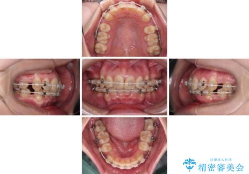 【モニター】横顔のシルエットをスッキリと ワイヤー装置による抜歯矯正治療の治療中