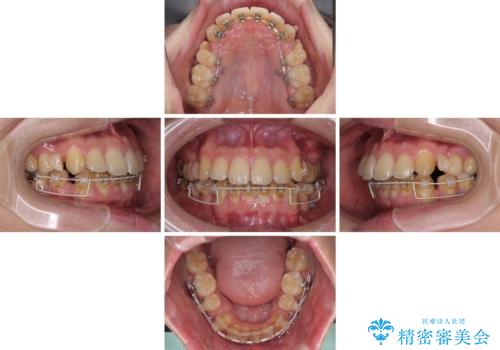 出っ歯と八重歯 目立たない裏側装置でスッキリとした口元にの治療中