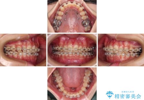 深い咬み合わせとデコボコの歯列をワイヤー矯正で改善の治療中