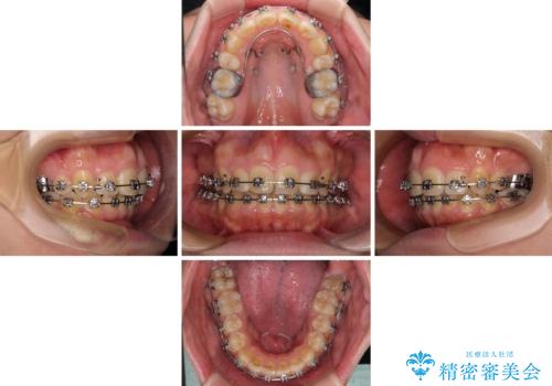 【モニター】後戻りで飛び出してきた前歯 ワイヤー装置での再矯正の治療中
