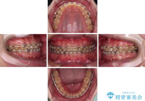 空隙歯列を閉じる　舌のトレーニングとワイヤー矯正の治療中