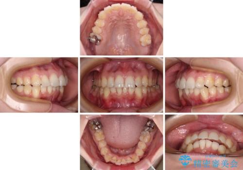 【モニター】前歯のデコボコをインビザラインで改善の治療中