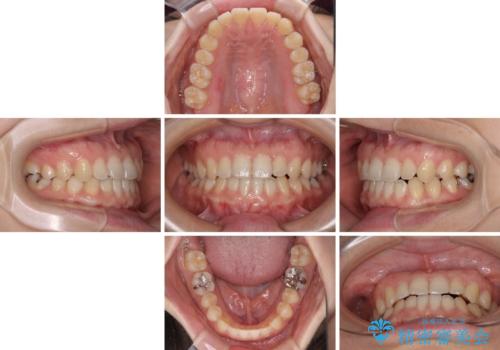 前歯のクロスバイト インビザラインによる矯正治療の治療中
