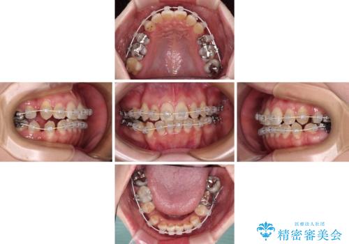 インビザラインが続けられない 装置変更して抜歯矯正の治療中