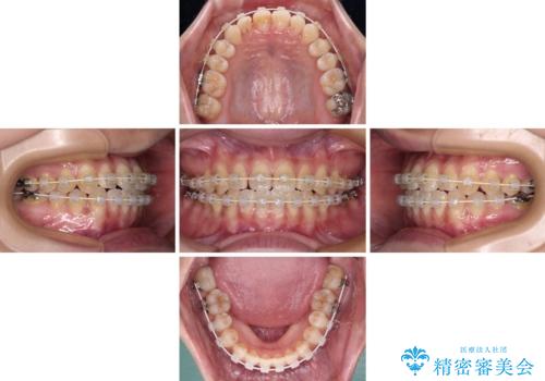 前歯のクロスバイトを治したい ワイヤー装置による矯正治療の治療中