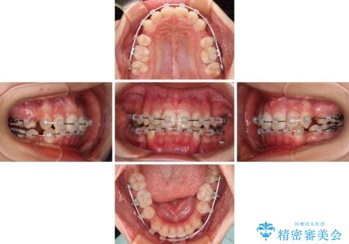 八重歯と乱れた咬み合わせを改善 ワイヤー装置での抜歯矯正の治療中