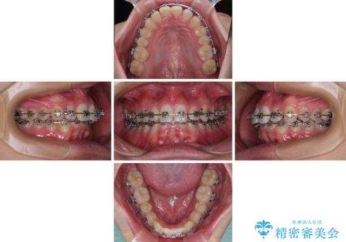 欠損した前歯とディープバイト ワイヤー矯正で短期間で治療の治療中