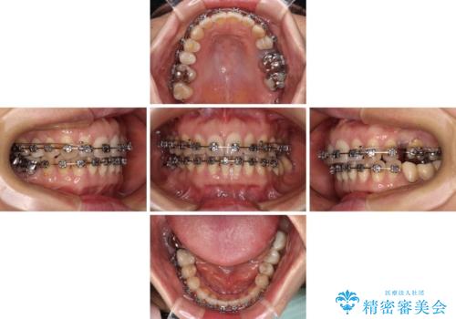 正中のズレと飛び出した前歯を改善 メタルブラケットでの抜歯矯正の治療中