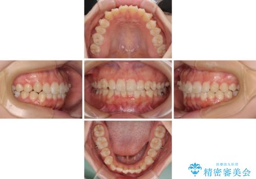 前歯のデコボコを整える インビザラインによる矯正治療の治療中
