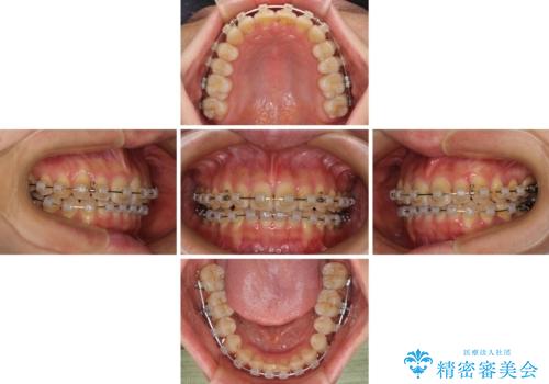 手間をかけずに治したい 短期間のワイヤー矯正の治療中