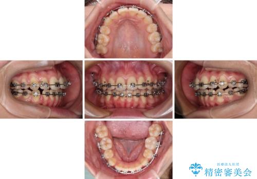【モニター】舌のトレーニングを行いながら後戻りの再矯正の治療中