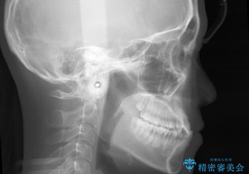 【非抜歯】受け口の改善 10代で始める本格的噛み合わせ治療の治療前