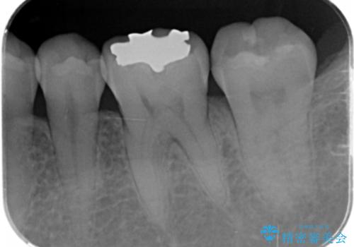 目立つ銀歯をセラミックへの治療前