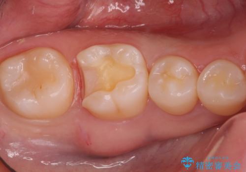 見た目にはわかりにくい奥歯の虫歯 セラミックインレーでの治療の治療中