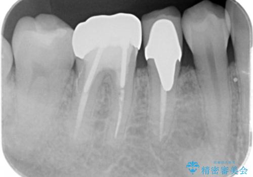 目立つ銀歯を白くしたい ジルコニアクラウンでの修復の治療前