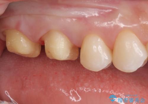 銀歯を白くしたいの治療中