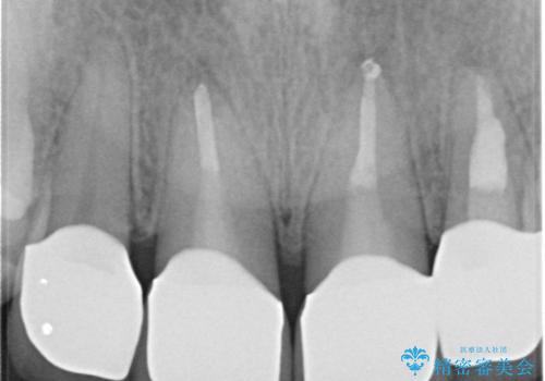 自然な前歯にしたい ジルコニアクラウンでの修復の治療後