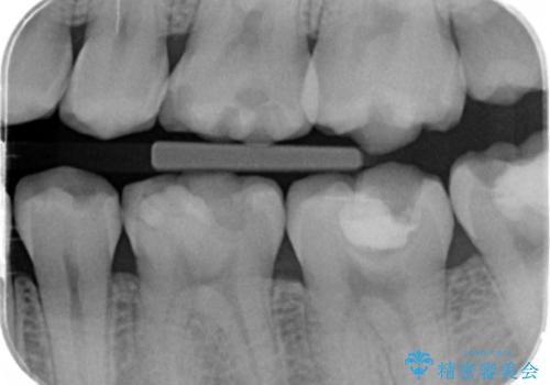 奥歯がしみる 神経を温存する治療の治療前