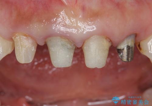 自然な前歯にしたい ジルコニアクラウンでの修復の治療中