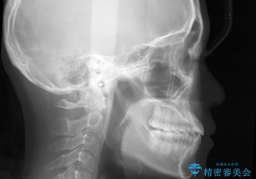【非抜歯】受け口の改善 10代で始める本格的噛み合わせ治療の治療後