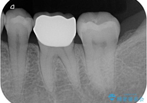 目立つ銀歯をセラミックへの治療後