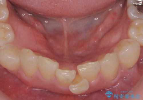 インビザラインで行う前歯のみの部分矯正の治療前