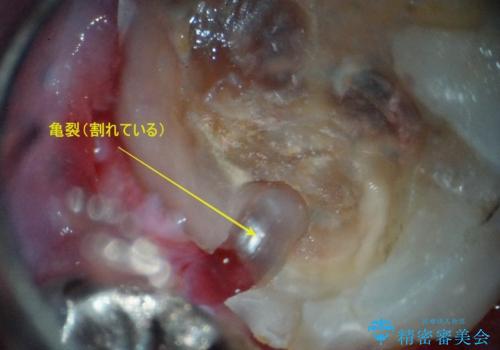 【インプラント】食事中に歯が割れた! かなり深いところまで歯が割れていたの治療中