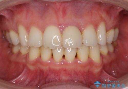 変色してきた前歯をセラミック治療の治療後