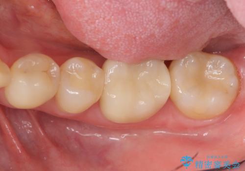 目立つ銀歯をセラミックへの治療後