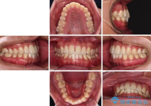 【モニター】楽して治したい メタルブラケットによる矯正治療の治療前