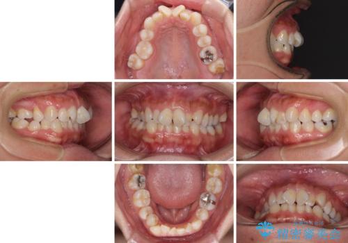 既に2本が抜歯されている歯列　咬み合わせのズレを改善する抜歯矯正の治療前