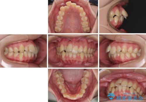【モニター】横顔のシルエットをスッキリと ワイヤー装置による抜歯矯正治療の治療前