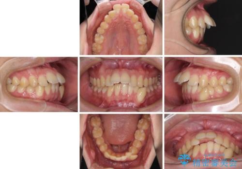出っ歯と八重歯　目立たない裏側装置でスッキリとした口元にの治療前
