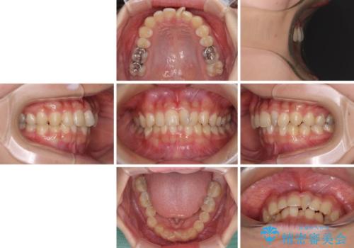 深い咬み合わせとデコボコの歯列をワイヤー矯正で改善の治療前