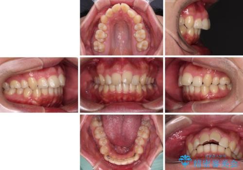 【モニター】後戻りで飛び出してきた前歯 ワイヤー装置での再矯正の治療前