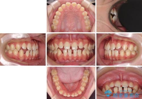 空隙歯列を閉じる 舌のトレーニングとワイヤー矯正の治療前