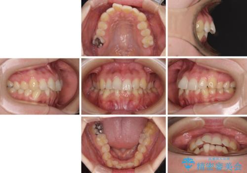【モニター】前歯のデコボコをインビザラインで改善の治療前