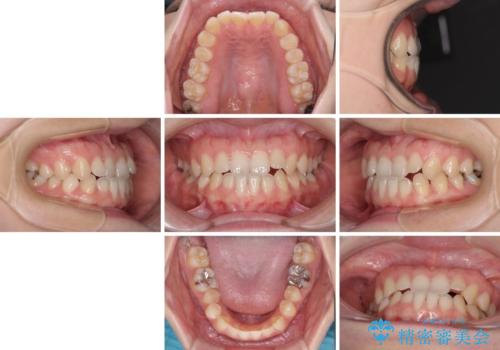 前歯のクロスバイト インビザラインによる矯正治療の治療前