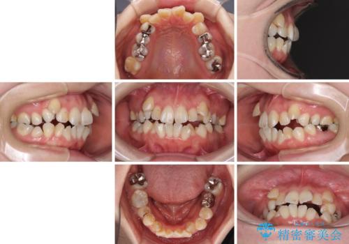 インビザラインが続けられない 装置変更して抜歯矯正の治療前