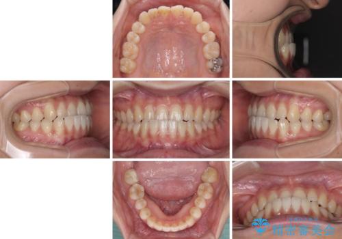 前歯のクロスバイトを治したい ワイヤー装置による矯正治療の治療前
