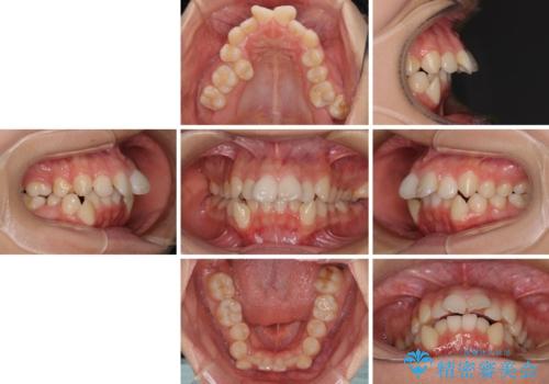 八重歯と乱れた咬み合わせを改善　ワイヤー装置での抜歯矯正の治療前