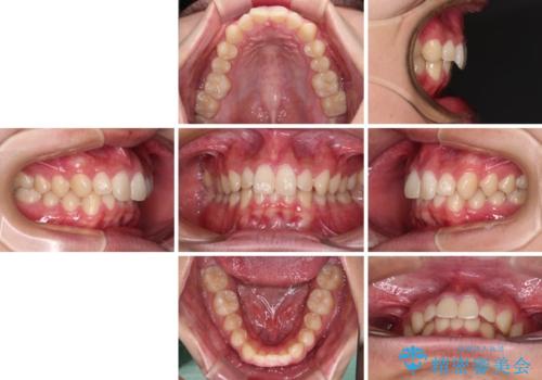 欠損した前歯とディープバイト ワイヤー矯正で短期間で治療の治療前