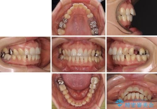 正中のズレと飛び出した前歯を改善　メタルブラケットでの抜歯矯正の治療前