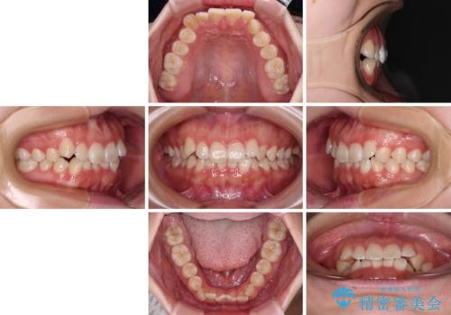 前歯のデコボコを整える インビザラインによる矯正治療の治療前
